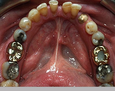 Lower jaw showing many metal fillings. Patient in Waterloo, Ontario