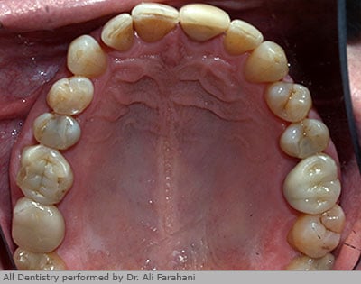Upper jaw showing new white fillings that replaced old amalgam fillings.