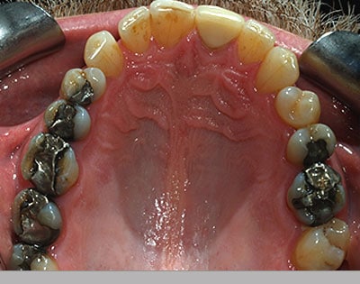 Upper jaw showing many mercury fillings.