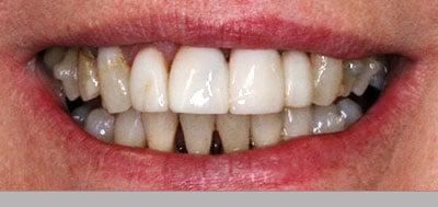 Smile before comfortable bite dental procedure