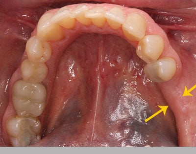 Mouth showing missing teeth and corresponding loss of jawbone