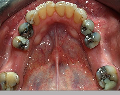 Teeth before comfortable bite dental procedure