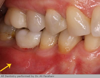 After bone regeneration, dental implant and gum regeneration.