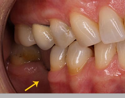 Mouth showing missing back tooth with loss of jawbone