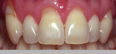 Receding gums before gum regeneration.