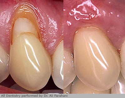 Before and after gum regeneration