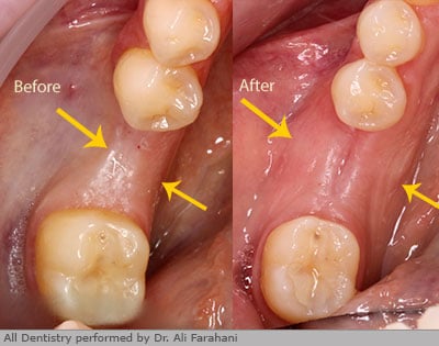 Before & After photos of bone regeneration.