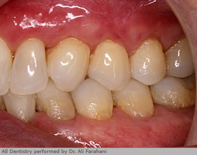 Mouth after gum regeneration