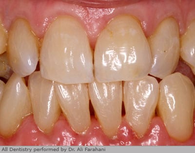 Front teeth after gum regeneration