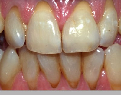 Receding gums before gum regeneration.
