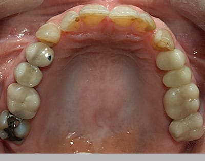 Teeth before comfortable bite dental procedure