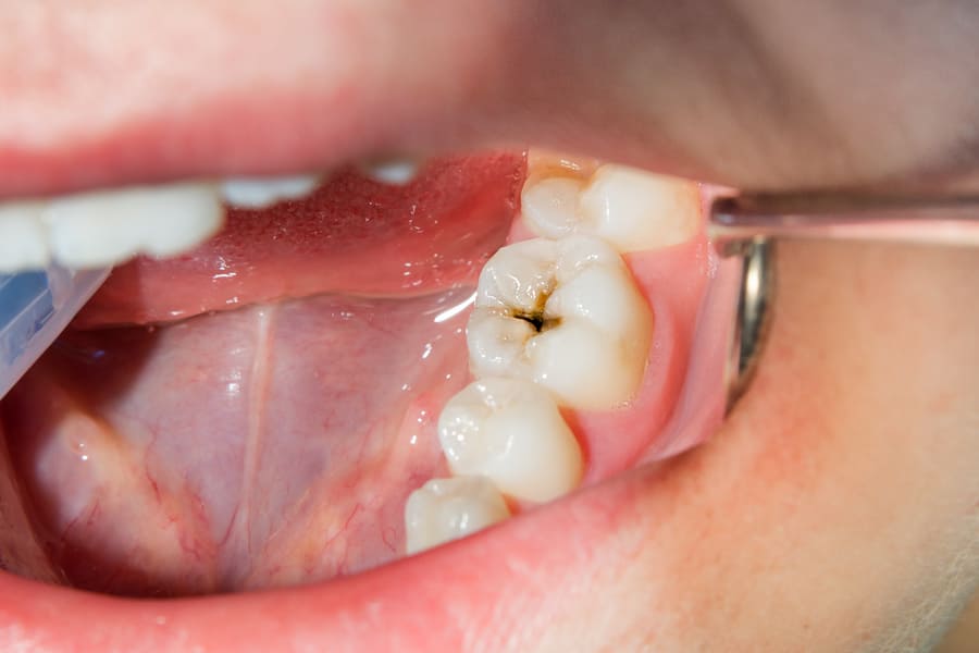 Cavities