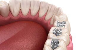 model of old silver amalgamation fillings